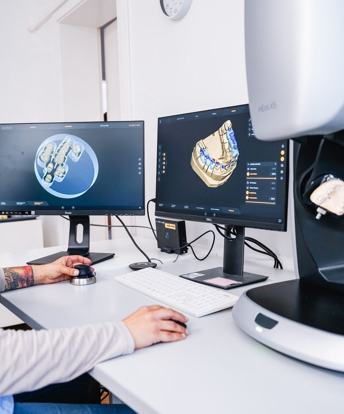 Digitale Planung von Zahnersatz am Bildschirm